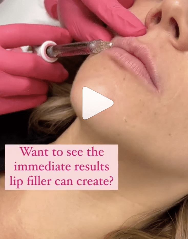 Instagram reel. Lip filler. Results. Before and after. Procedure. Mona Dermatology Cincinnati.